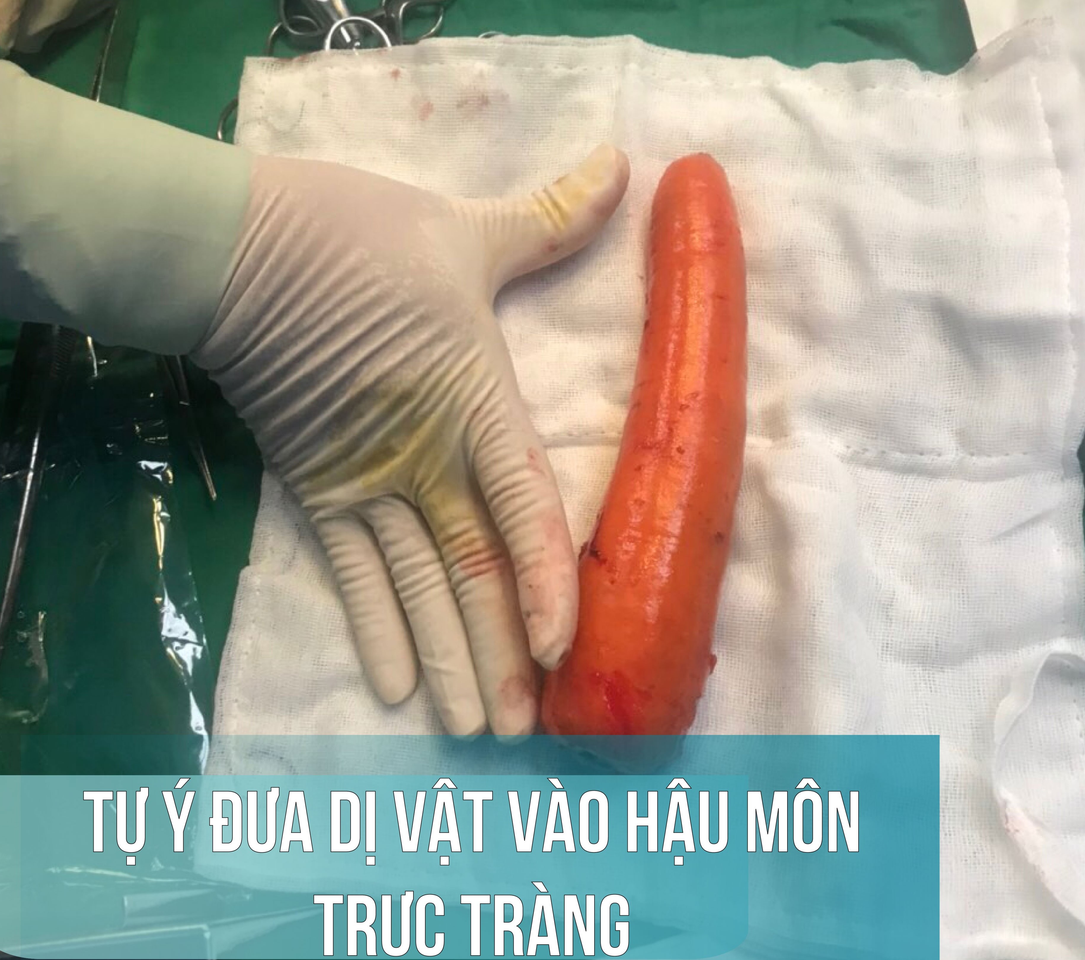 Cứu thiếu niên bị kẹt củ cà rốt dài 20 cm trong hậu môn