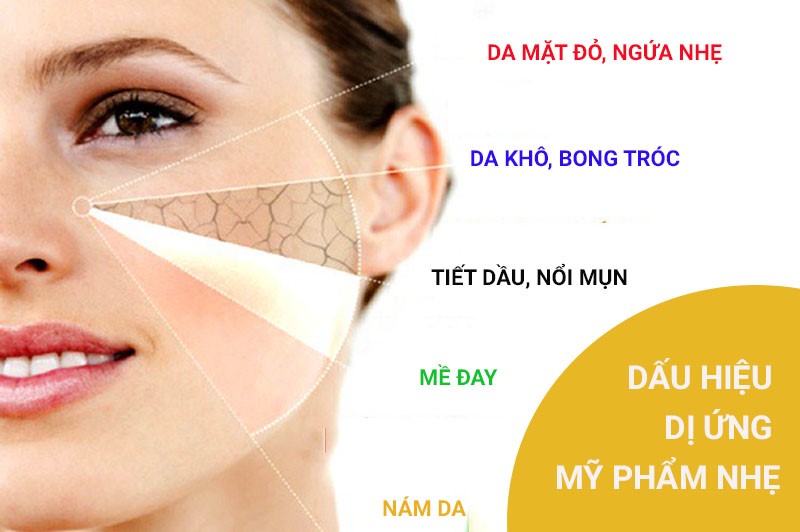 Dấu hiệu dị ứng mỹ phẩm nhẹ: Cách nhận biết và xử lý an toàn