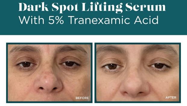 Review serum VI Derm Dark Spot Lifting có trị nám và ngăn ngừa tái phát không? - Ảnh 8. Review serum VI Derm Dark Spot Lifting có trị nám và ngăn ngừa tái phát không? - Ảnh 8.