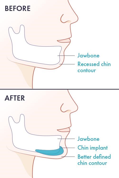 Những dáng cằm thích hợp để thực hiện độn cằm V-Line - Ảnh 2.