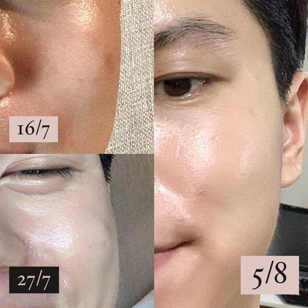 Hướng dẫn sử dụng serum trị nám VI Derm Dark Spot Lifting đạt hiệu quả - Ảnh 3. Hướng dẫn sử dụng serum trị nám VI Derm Dark Spot Lifting đạt hiệu quả - Ảnh 3.