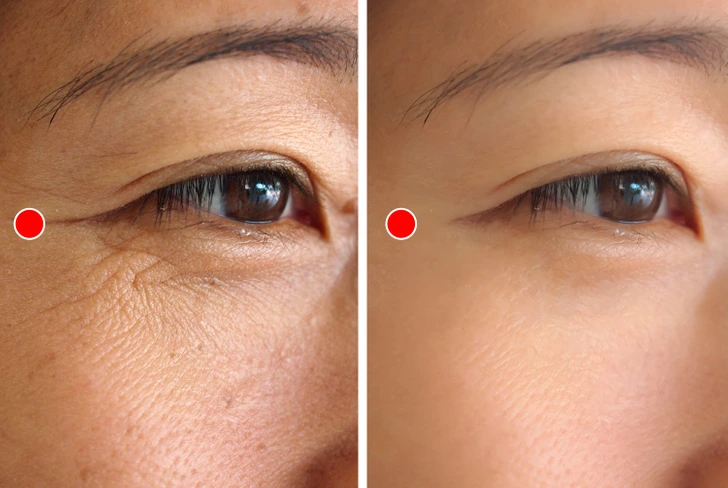 Những vết chân chim ở mắt và điều cần biết khi xóa nếp nhăn bằng botox