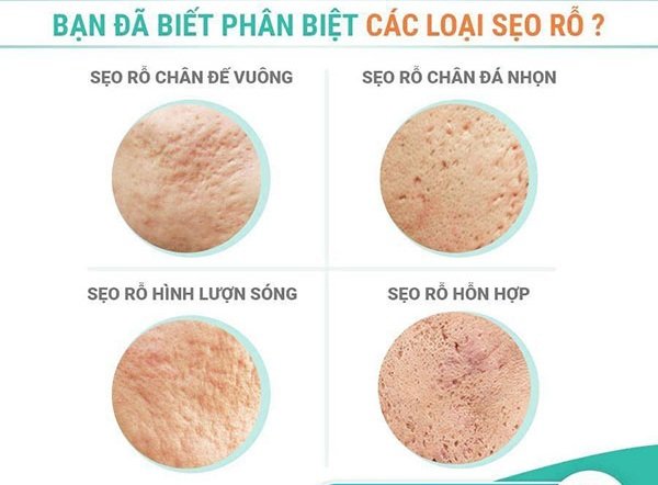 Sẹo rỗ, “vị khách không mời” bị loại bỏ từ những công nghệ mới - Ảnh 2. Sẹo rỗ, “vị khách không mời” bị loại bỏ từ những công nghệ mới - Ảnh 2.