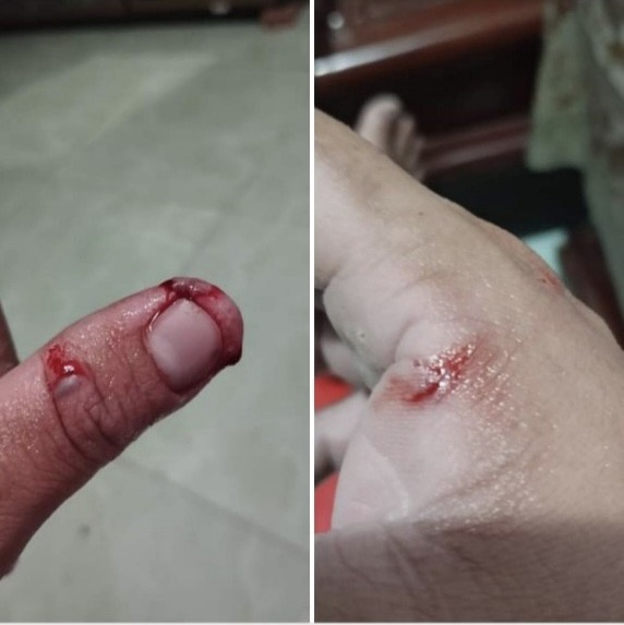 Người đàn ông tử vong sau bị bị chó nhà cắn nhưng không tiêm ngừa - Ảnh 1. Người đàn ông tử vong sau bị bị chó nhà cắn nhưng không tiêm ngừa - Ảnh 1.