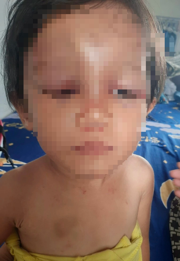 Cháu bé 3 tuổi bị cha nuôi bạo hành: Đưa cháu bé đi giám định thương tật - Ảnh 1. Cháu bé 3 tuổi bị cha nuôi bạo hành: Đưa cháu bé đi giám định thương tật - Ảnh 1.