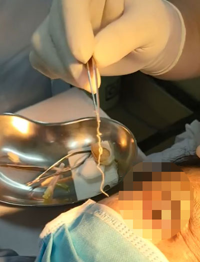 Gắp được con giun sán dài 10 cm trong mắt của người bệnh - Ảnh 1. Gắp được con giun sán dài 10 cm trong mắt của người bệnh - Ảnh 1.