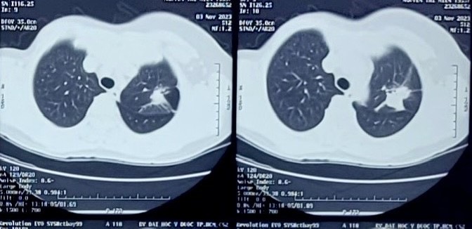 TP.HCM: Phẫu thuật robot cắt u phổi, điều trị ung thư phổi xâm lấn tối thiểu - Ảnh 1.