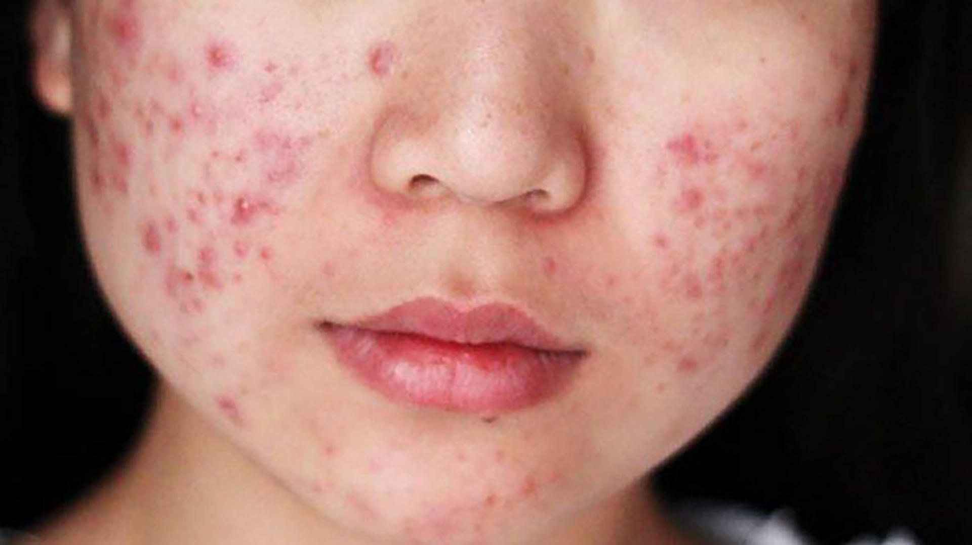 Actidem Derma Gel có đẩy mụn không? Cách sử dụng Actidem Derma Gel để đạt  hiệu quả?
