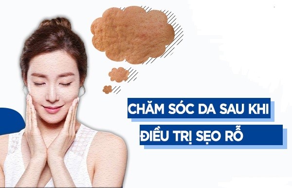 Có cần dùng thêm kem trị sẹo rỗ sau phương pháp bóc tách, laser không?- Ảnh 1.