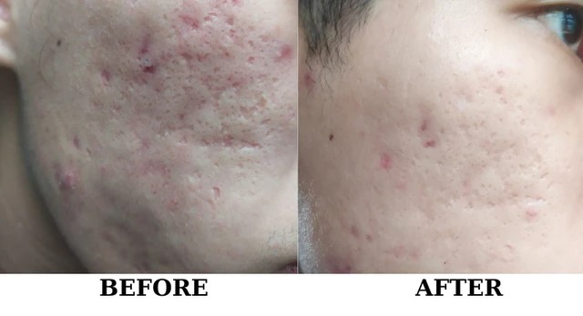 Có cần dùng thêm kem trị sẹo rỗ sau phương pháp bóc tách, laser không?- Ảnh 4. Có cần dùng thêm kem trị sẹo rỗ sau phương pháp bóc tách, laser không?- Ảnh 4.