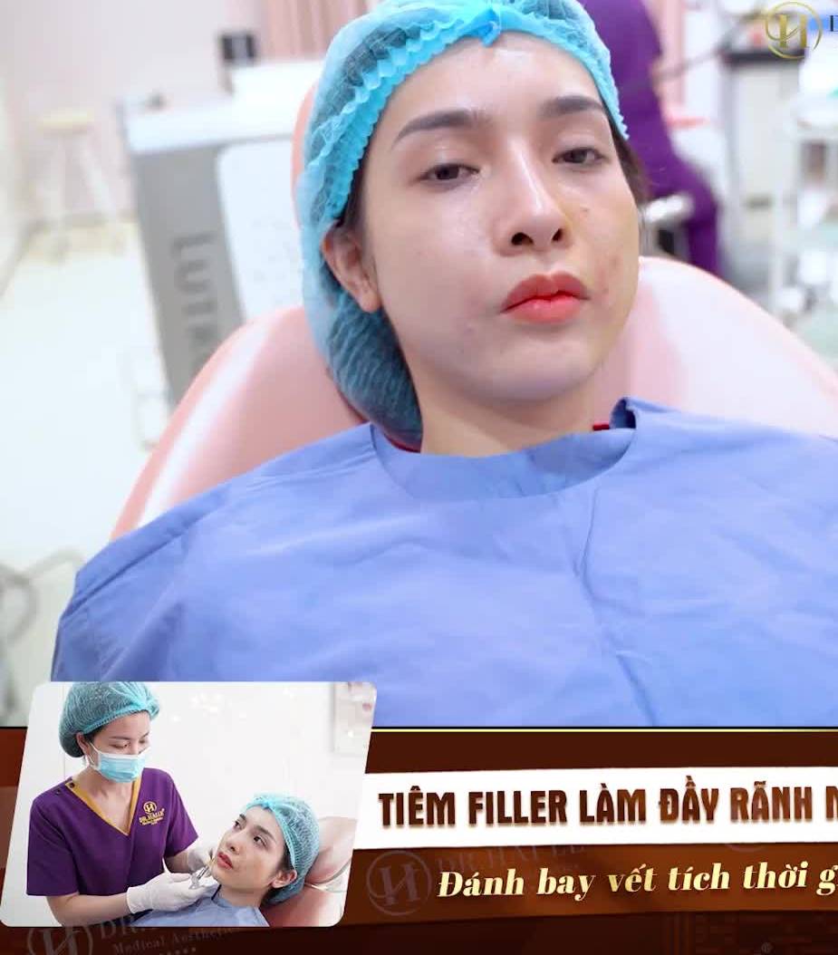 'Râu rồng' vẫn xuất hiện ở người trẻ khiến mặt bạn già nua, vì sao?