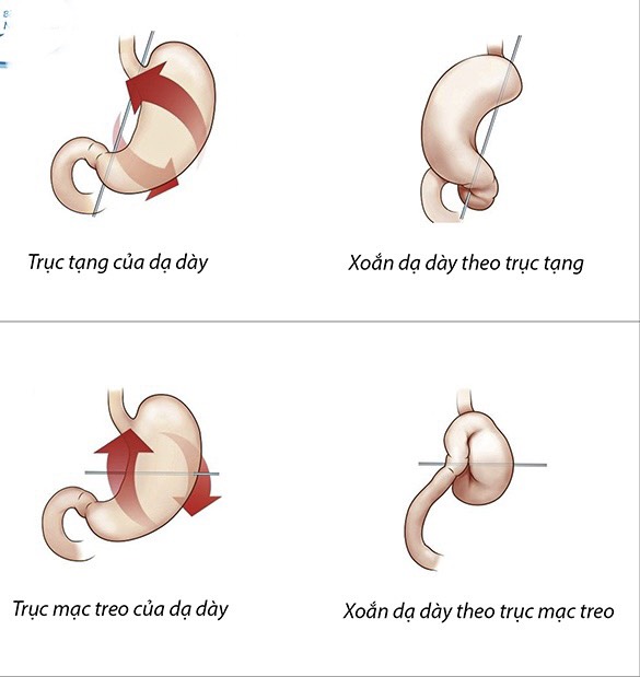   Bệnh xoắn dạ dày ở trẻ nhỏ - Ảnh 1.