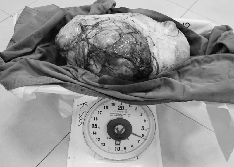 Quảng Ninh: Phẫu thuật cho cô gái 28 tuổi mang u buồng trứng nặng 6,5 kg - Ảnh 2.