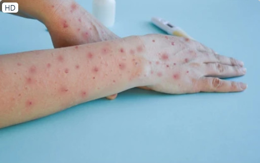 WHO cảnh báo triệu chứng ban đầu khi nhiễm bệnh Marburg rất giống các cơn sốt khác - Ảnh 2.