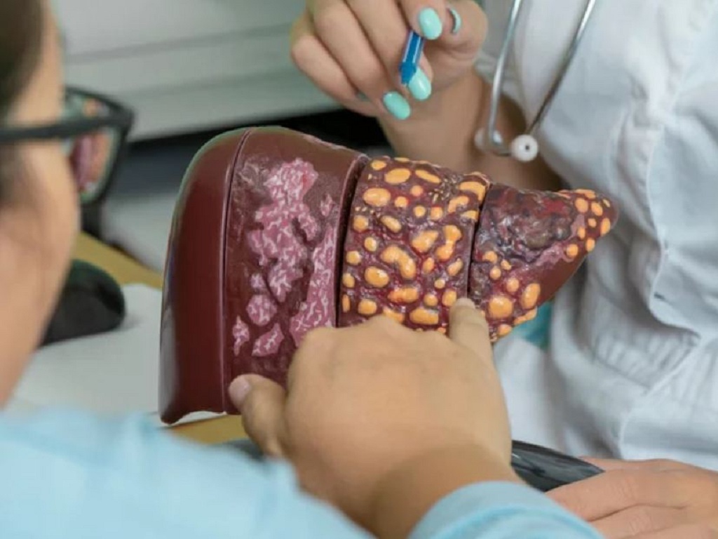 Bị gan nhiễm mỡ, điều chỉnh chế độ ăn thế nào để ngăn bệnh tiến triển?