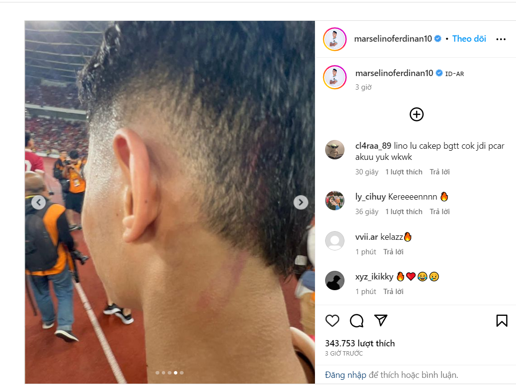 Sao trẻ đội tuyển Indonesia đăng tải bức ảnh bầm tím sau trận đấu ...