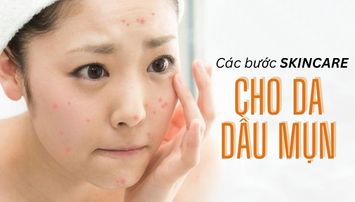 Gợi ý Liệu Trình Skincare Trị Mụn Từ Các Thương Hiệu Nổi Tiếng Mà Giá ...