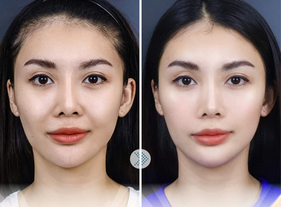 Bác sĩ thẩm mỹ chỉ rõ độ tuổi nào nên căng chỉ rãnh mũi, má