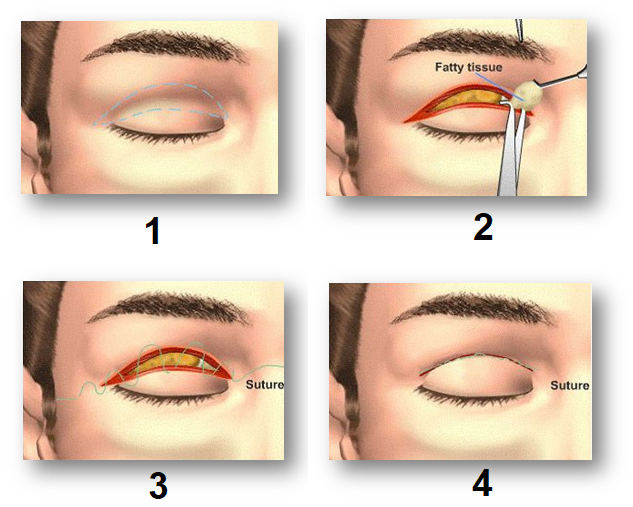 Tạo hình phẫu thuật thẩm mỹ mắt, hiểu đủ, chọn đúng để có đôi mắt đẹp, khỏe - Ảnh 4.