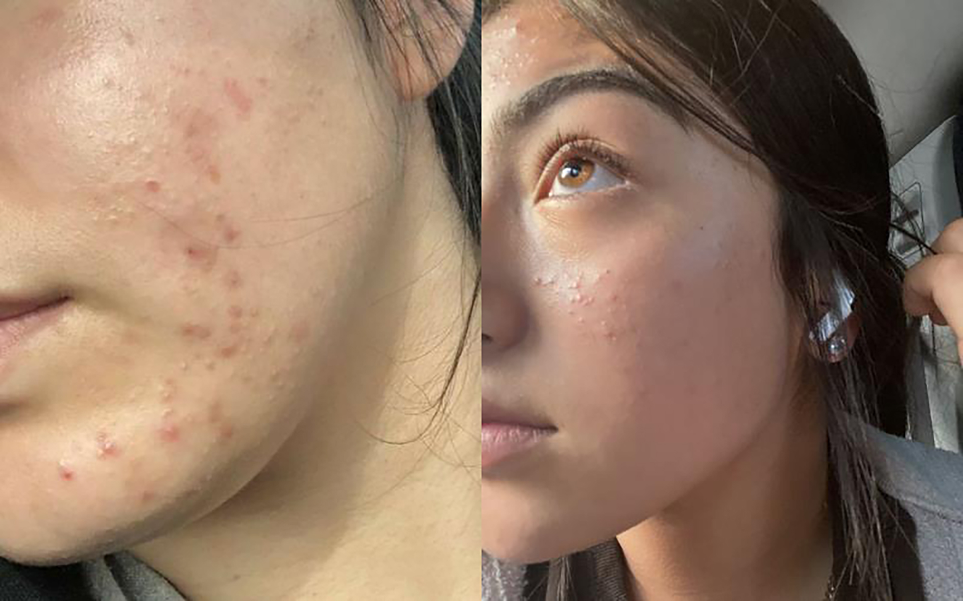 Điều trị mụn tuổi dậy thì bao lâu mới thấy hiệu quả?