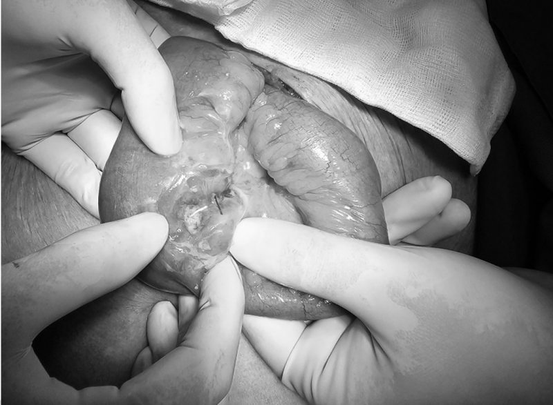 Quang Ninh: Wanita berusia 83 tahun mengalami usus halus tertusuk tulang ikan - Foto 1. Quảng Ninh: Cụ bà 83 tuổi bị xương cá đâm thủng ruột non  - Ảnh 1.