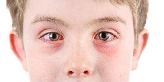 Đau mắt đỏ: Cách ngăn ngừa lây lan ở trẻ, khi nào cần đi bác sĩ - Ảnh 1.