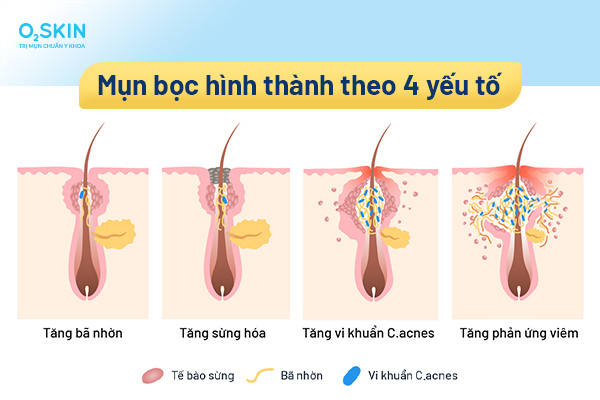 Mụn bọc dai dẳng, nguyên nhân và cách điều trị đúng- Ảnh 3.