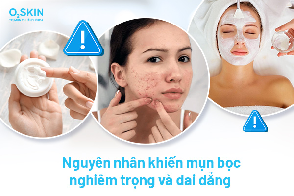 Mụn bọc dai dẳng, nguyên nhân và cách điều trị đúng - Ảnh 2.