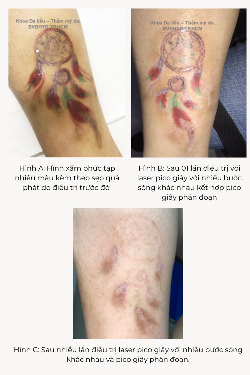 Nước Xóa Hình Scan Xăm Balm Tattoo – Sutuvang Supply