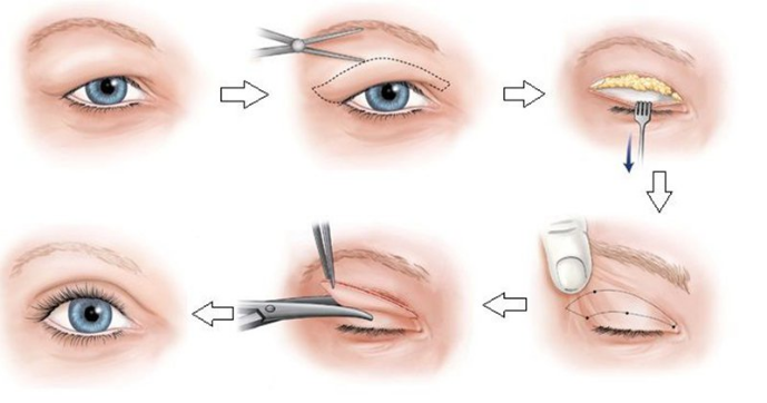 3. Những Thực Phẩm Nên Ăn Sau Khi Cắt Mí