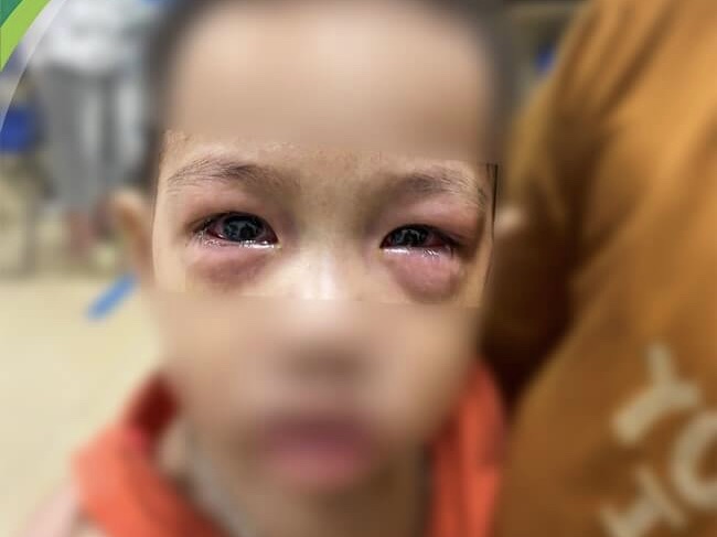 Cảnh báo biến chứng mù lòa do đau mắt đỏ - Ảnh 2.