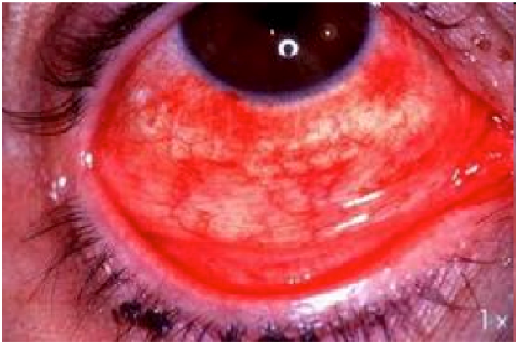 Cảnh báo biến chứng mù lòa do đau mắt đỏ - Ảnh 1.