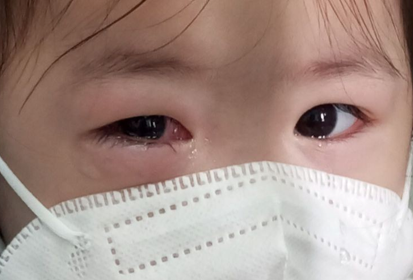 Đã xác định được 2 tác nhân gây bệnh đau mắt đỏ trên địa bàn TP.HCM - Ảnh 1.