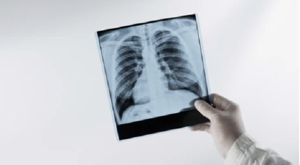 Vì sao nhiễm cúm A có thể khiến phổi trắng xóa?- Ảnh 1.