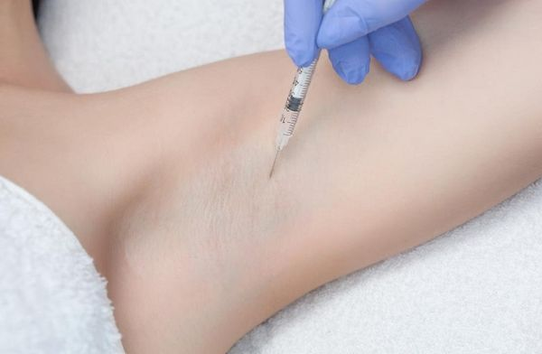 Giảm tiết mồ hôi bằng tiêm botulinum toxin- Ảnh 4.