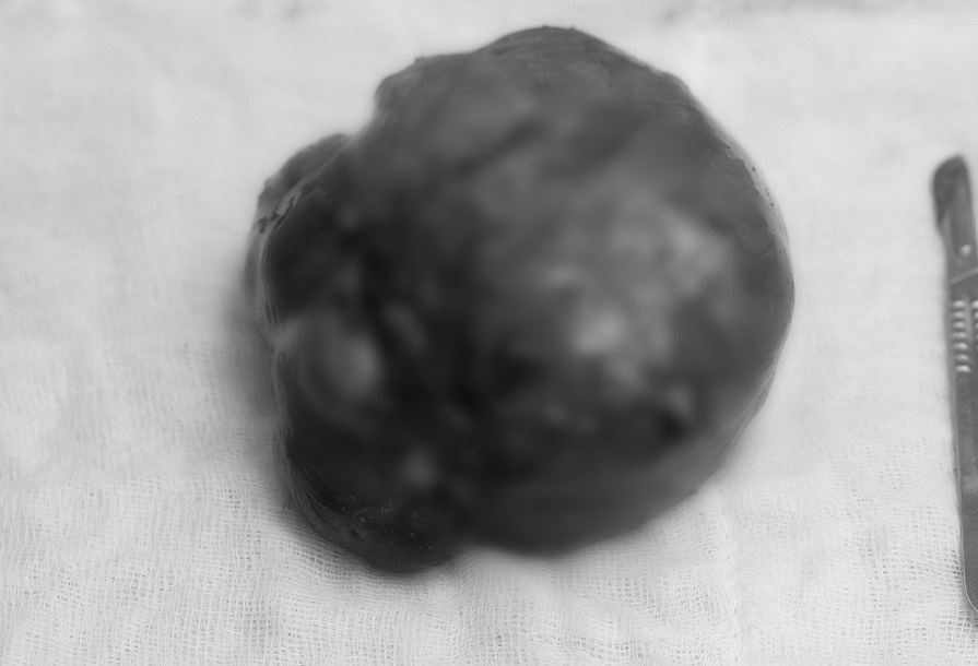 Att ta bort stora livmoderfibrer orsakar komplikationer av urinretention och infektion - Foto 1. Bóc u xơ tử cung kích thước lớn gây biến chứng bí tiểu, nhiễm trùng- Ảnh 1.