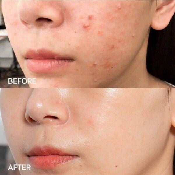 Top 10 serum trị mụn ẩn, mụn viêm, mụn trứng cá được tìm mua nhiều hiện nay- Ảnh 11.