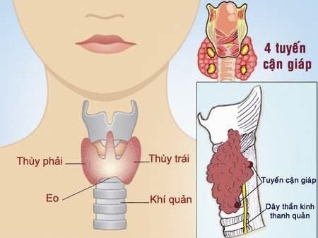 Gia tăng ca mắc ung thư tuyến giáp - Ảnh 1.