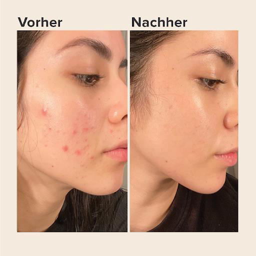 Top 10 sữa rửa mặt trị mụn được tín đồ skincare review nhiều hàng đầu hiện nay- Ảnh 9.