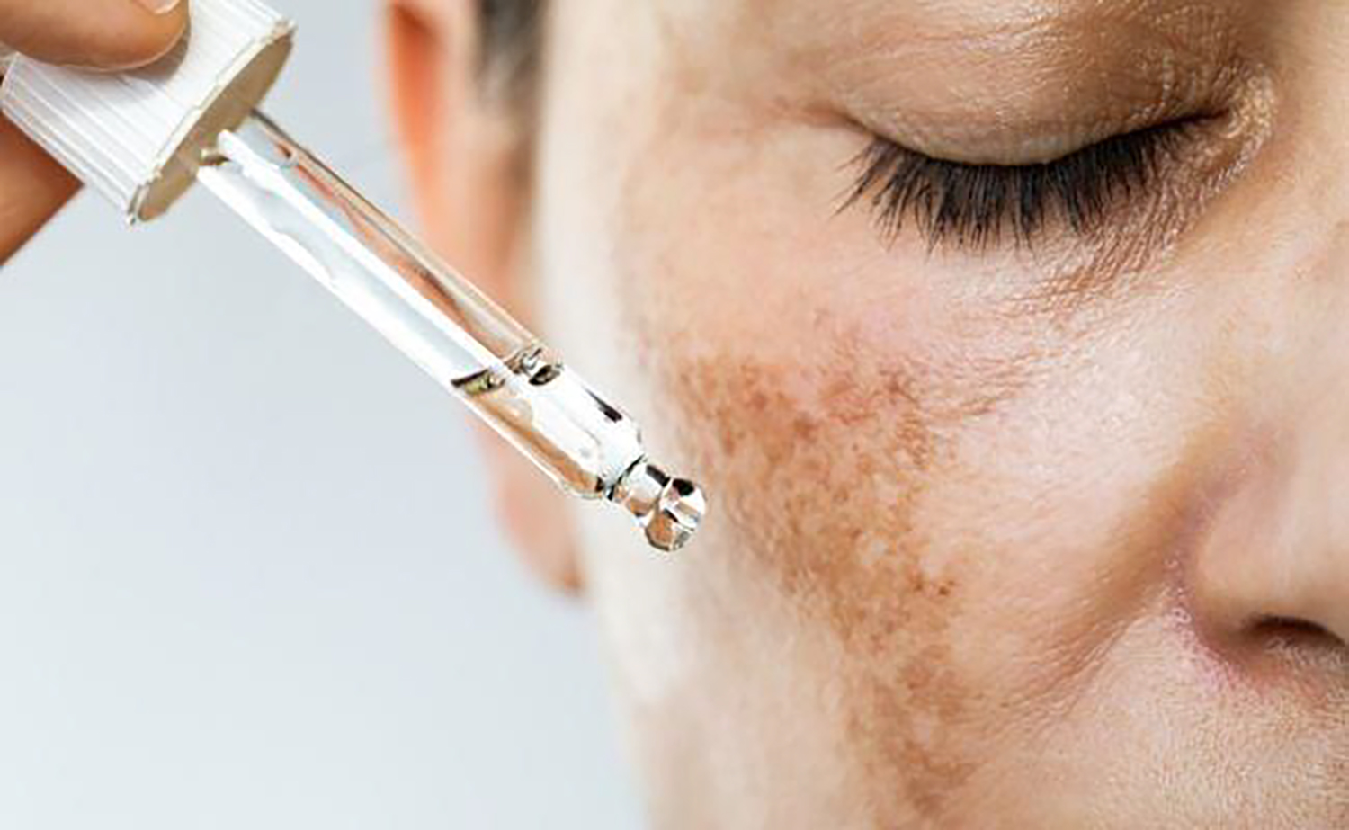 Top 10 serum Tranexamic Acid trị nám, tàn nhang cho làn da trắng hồng chỉ 4  tuần