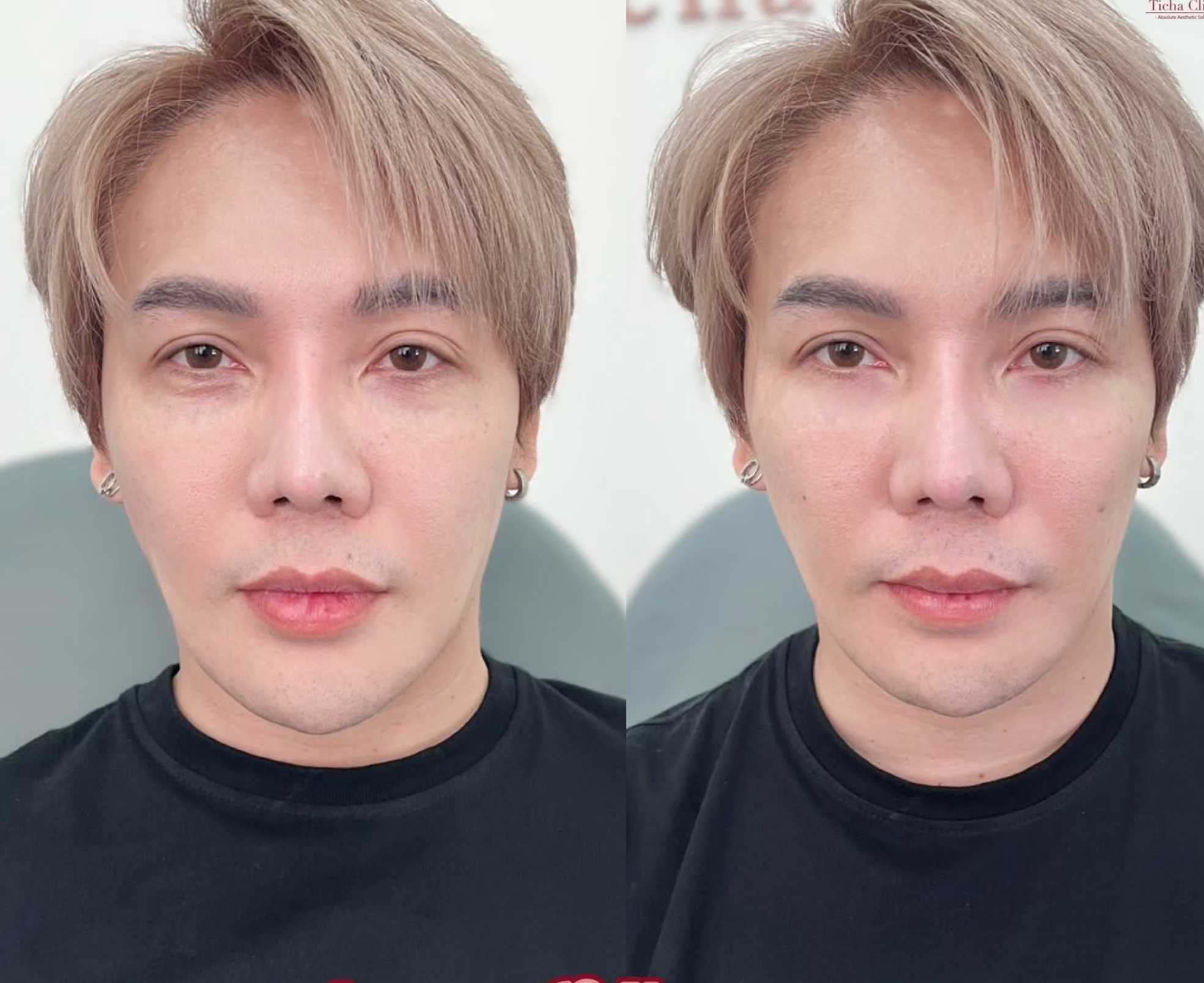 Hemligheten bakom påsar och mörka ringar under ögonen - Bild 2. Bí mật đằng sau bọng mắt và quầng thâm đen dưới mắt- Ảnh 2.