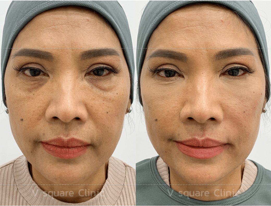 Hemligheten bakom påsar och mörka ringar under ögonen - Bild 1. Bí mật đằng sau bọng mắt và quầng thâm đen dưới mắt- Ảnh 1.