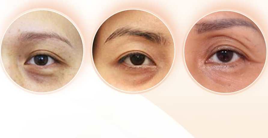 Hemligheten bakom påsar och mörka ringar under ögonen - Foto 3. Bí mật đằng sau bọng mắt và quầng thâm đen dưới mắt- Ảnh 3.