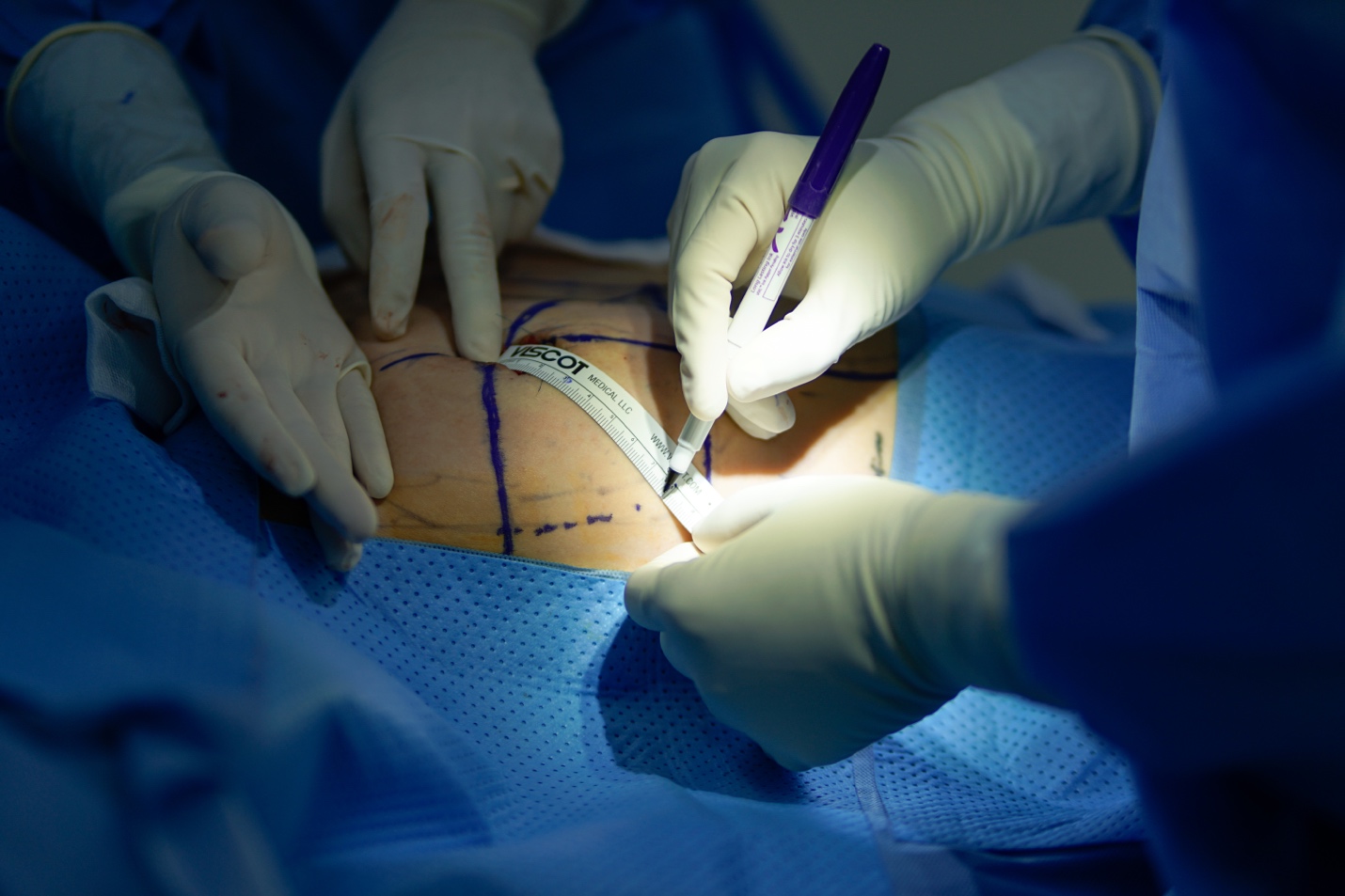 Nhược điểm tạo khoang bằng phương pháp phẫu tích mù trong nâng ngực- Ảnh 1.