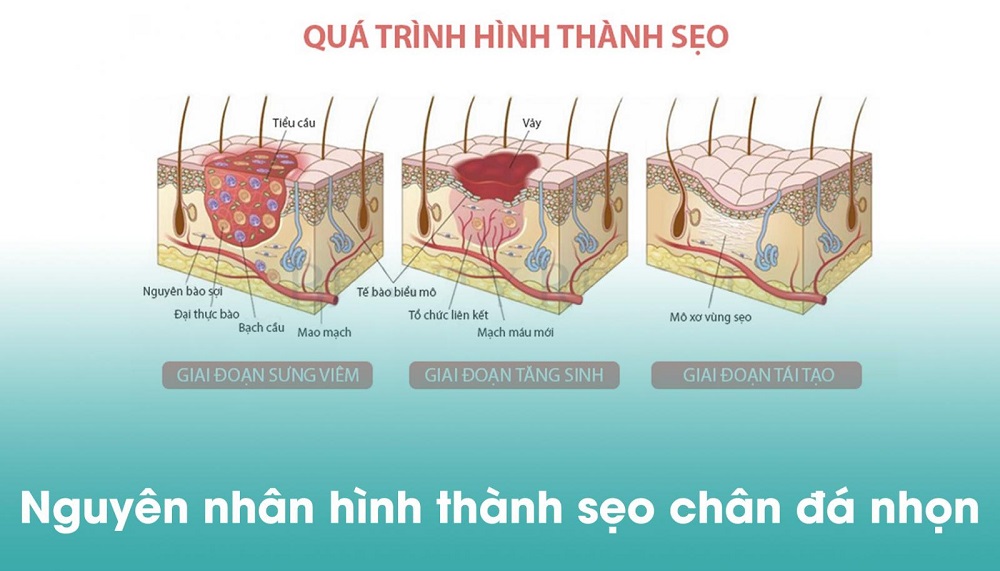 Sẹo đáy nhọn là gì? Top 5 cách điều trị sẹo đáy nhọn hiệu quả hiện nay- Ảnh 3.