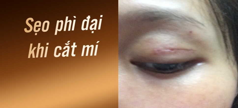 Kh&acirc;u thẩm mỹ c&oacute; để lại sẹo kh&ocirc;ng? L&agrave;m thế n&agrave;o điều trị sẹo hiệu quả?- Ảnh 3.