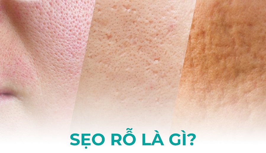 Top 7 phương pháp trị sẹo rỗ hiệu quả đang được áp dụng phổ biến