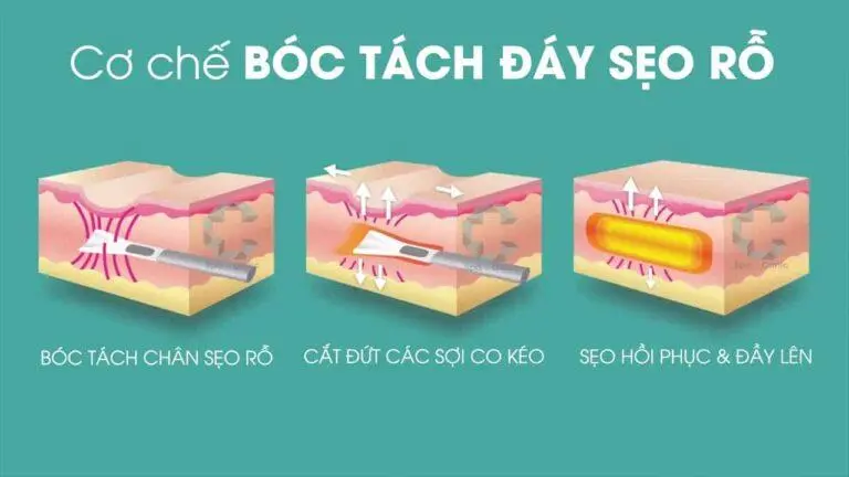 Top 7 phương pháp trị sẹo rỗ hiệu quả đang được áp dụng phổ biến