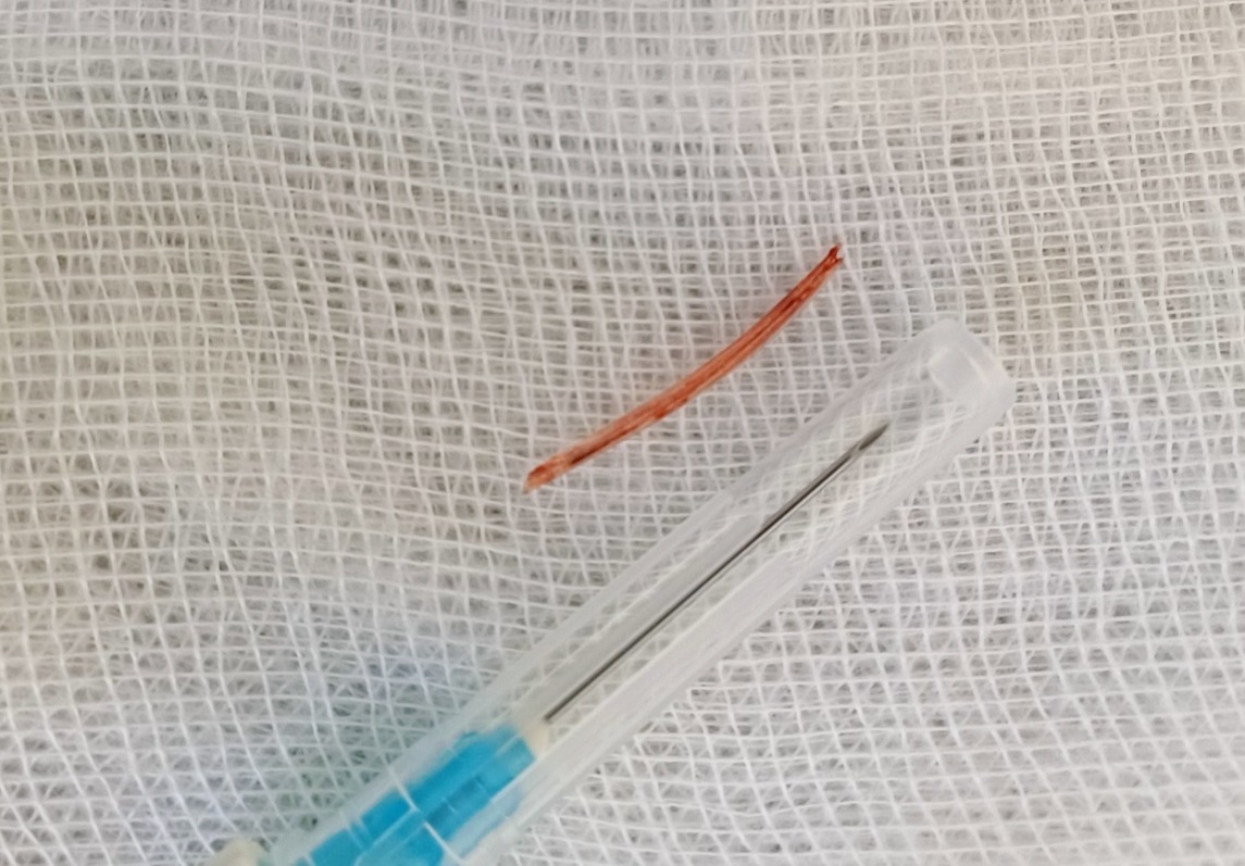 Cụ ông bị mảnh xương cá đâm thủng dạ dày nguy kịch- Ảnh 1. Mảnh xương cá dài 2,5 cm sau khi gắp ra thành công
