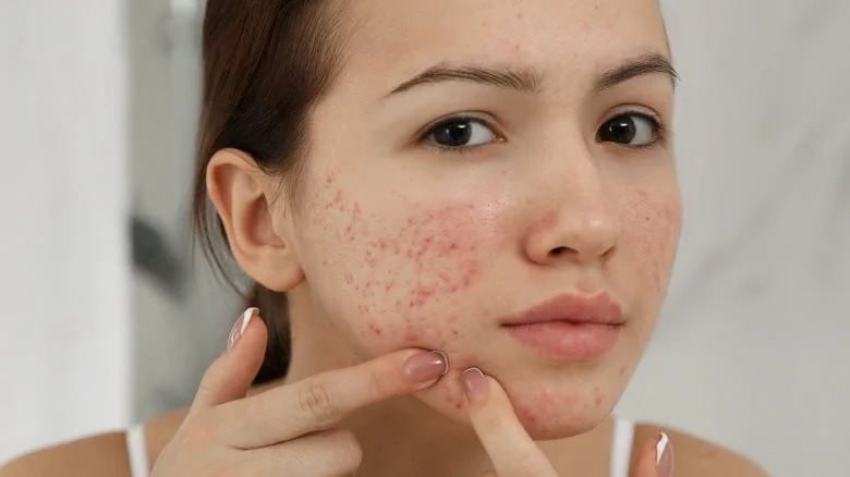 Điều gì sẽ xảy ra nếu bạn không rửa mặt buổi tối mỗi ngày?